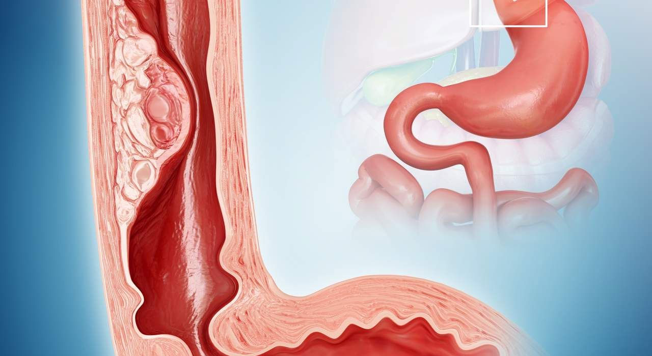 oesophageal dilation procedure related treatment and service by Dr. Gajanan Rodge, best gastroenterologists in Mumbai